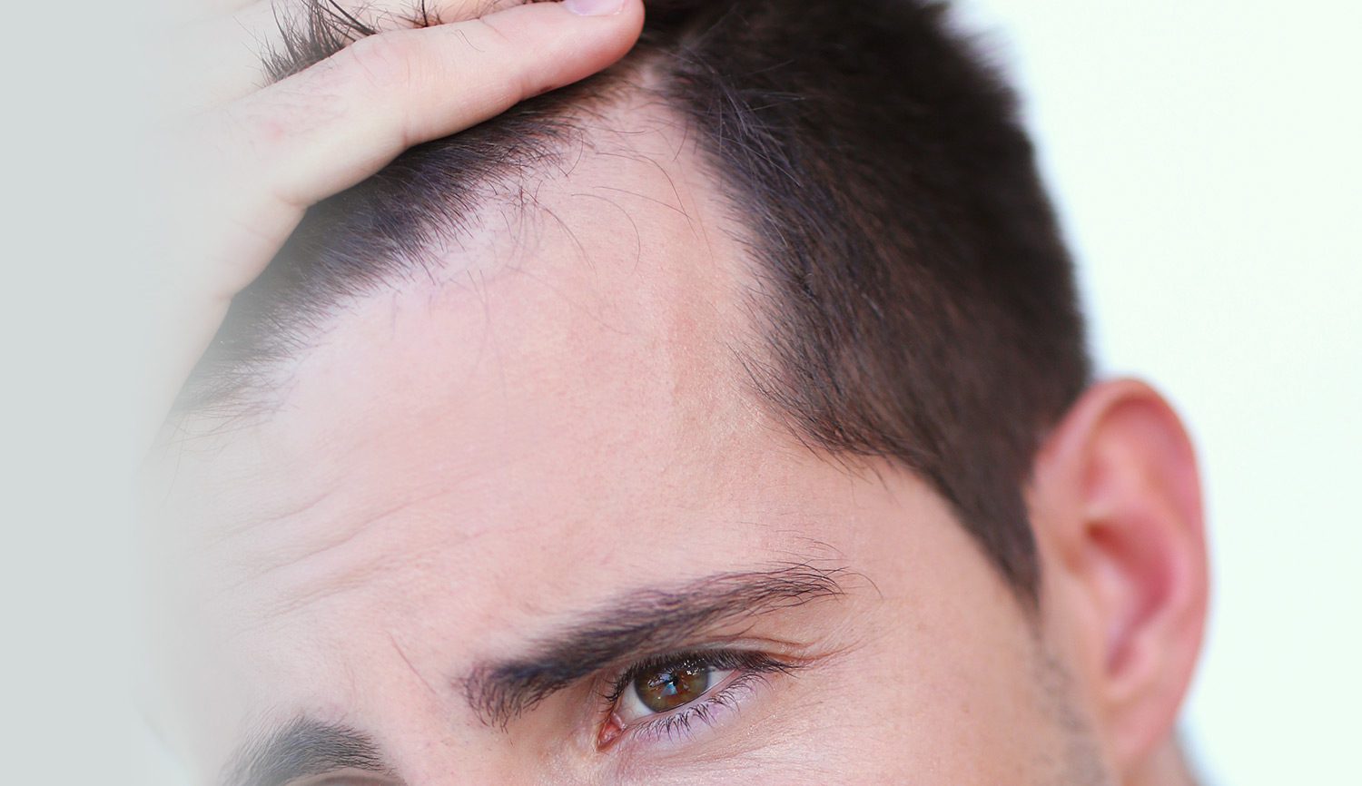 m字はげの原因と対策｜自分の頭皮に合った育毛剤の選び方 | チャップアップラボ | 薄毛に悩む方に